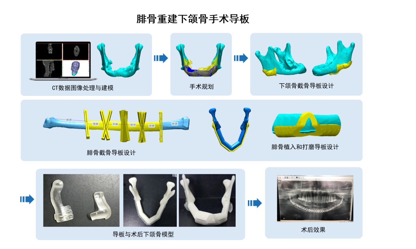 3D打印醫(yī)療應(yīng)用